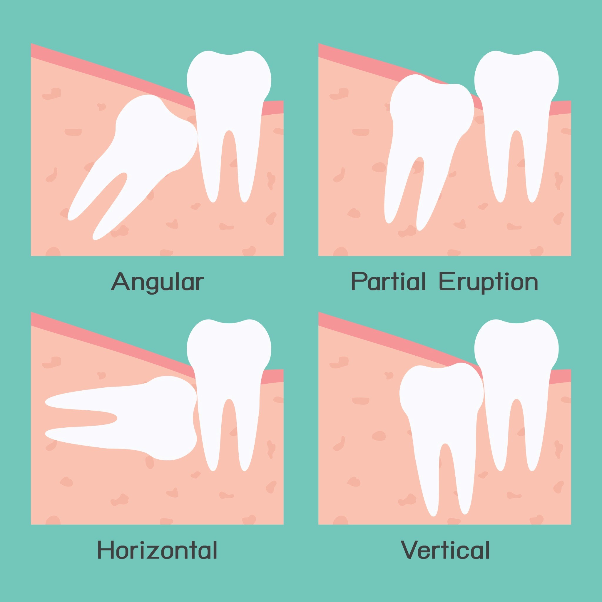 wisdom-teeth-smylor-dental-treatment-marketplaces